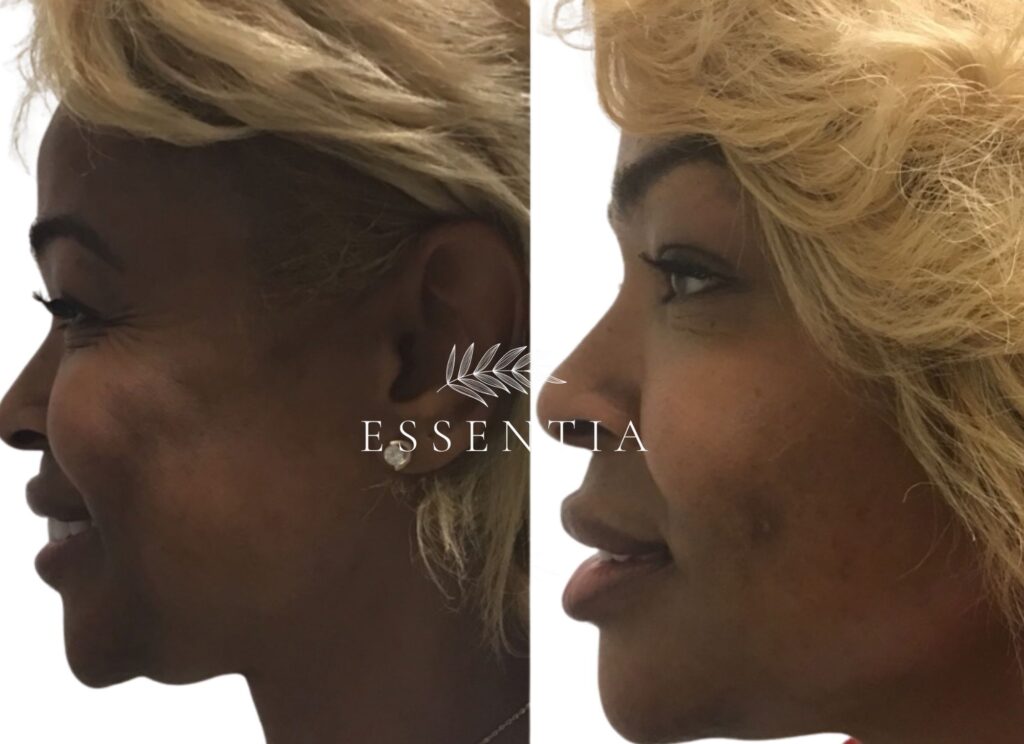 woman botox before and after crow's lines smile lines