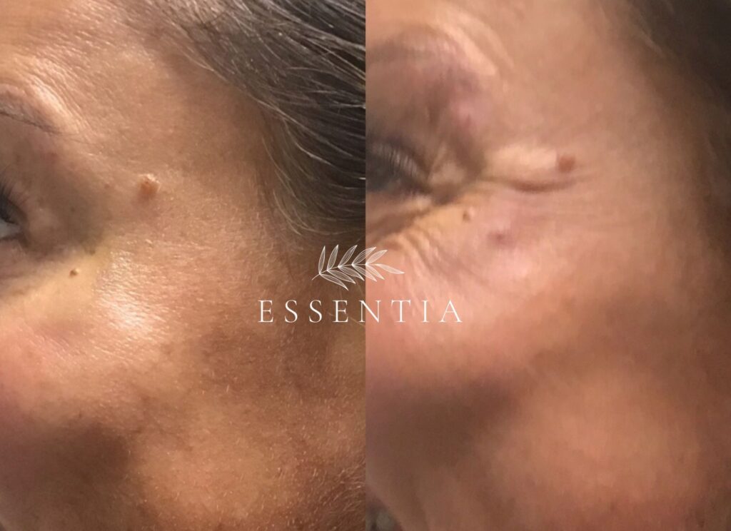woman botox before and after crow's lines smile lines