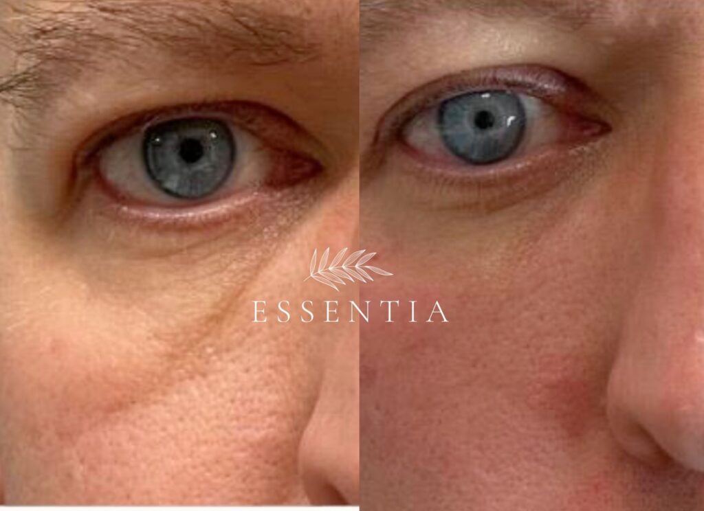 man PRP before and after facial balancing and skin rejuvenation
