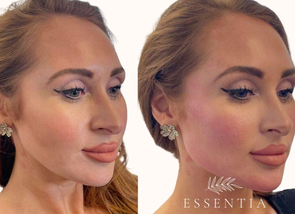 woman PRP before and after facial balancing and skin rejuvenation