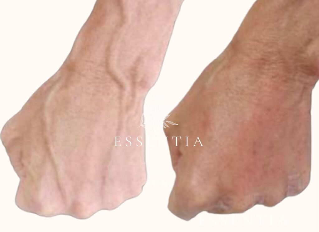prp before and after hands anti-aging