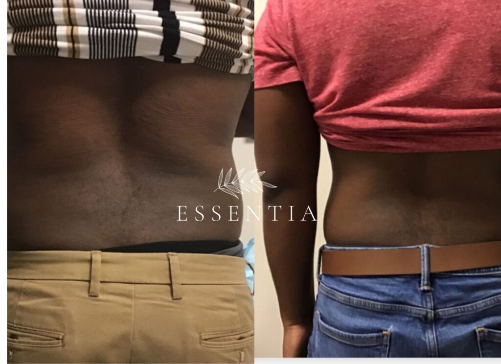 weight loss before and after GLP1