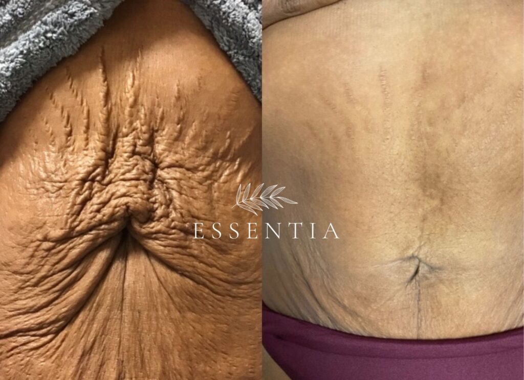 before and after skin tightening stretch mark treatment weight loss morpheus8 alternative to tummy tuck non surgical mommy makeover