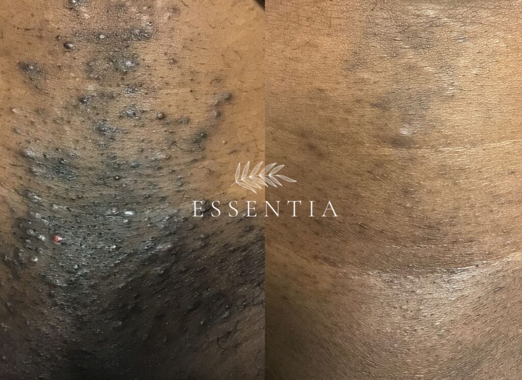 before and after laser hair removal ingrown hair treatment